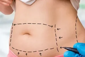 Cosmetic surgery Islamabad