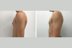 gynecomastia