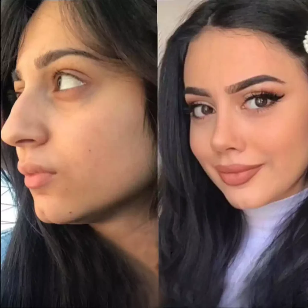 nose surgery in dubai