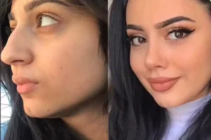 nose surgery in dubai