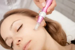 Microneedling for Acne Scars