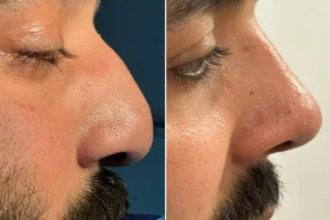 Rhinoplastic surgery Islamabad