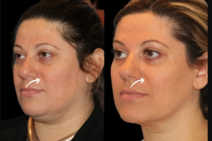 Sculptra Fillers Treatments in Dubai