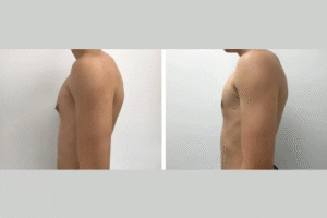 gynecomastia in Dubai