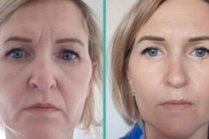 7D Hifu facial treatment