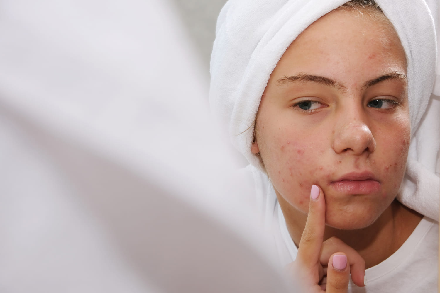 Acne Treatment Dubai
