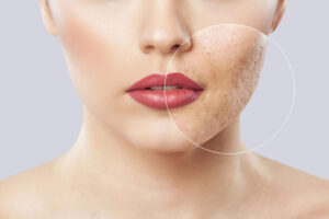 Acne Treatment Dubai