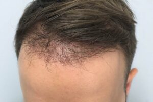 Hair Transplant in Dubai