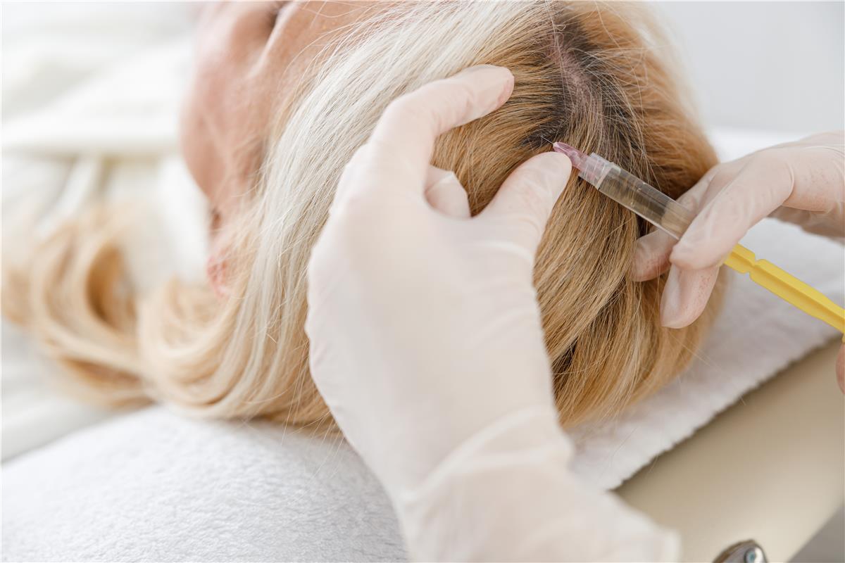 Best PRP Hair Treatment in Dubai