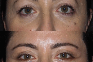 Eye Bag Removal