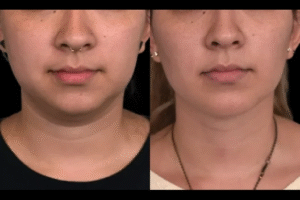 Double chin removal