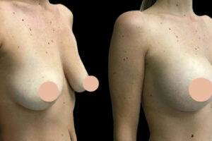 Breast Augmentation in Dubai