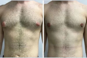 Gynecomastia Surgery in Dubai: Cost, Procedure, and Recovery Explained