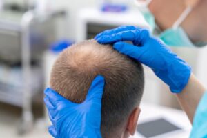 Hair Transplant in Dubai
