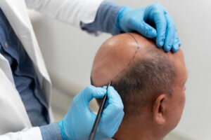 Hair Transplant in Dubai