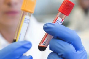 Vitamin D Deficiency? Book a Blood Test at Home in Dubai Today
