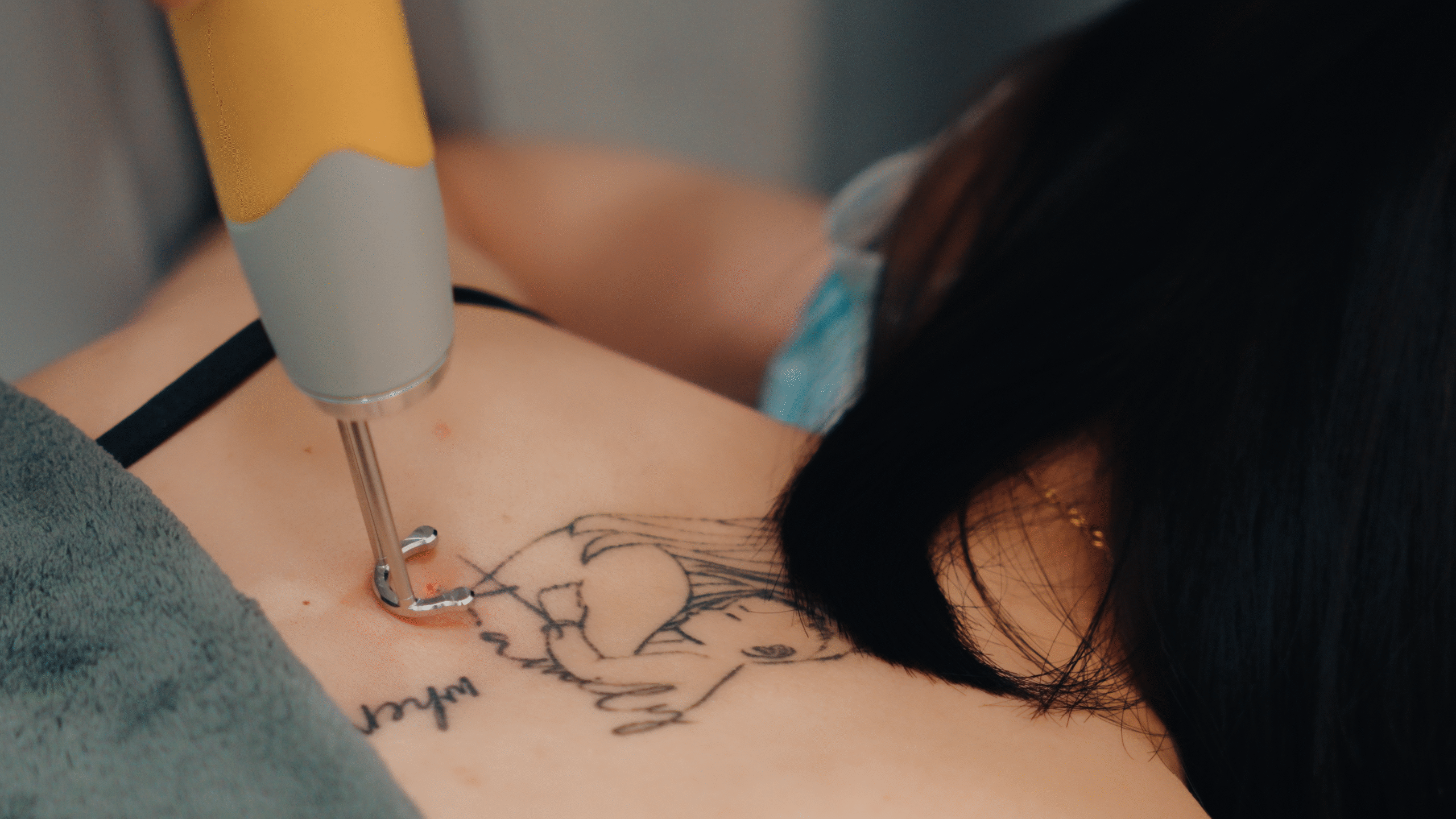Laser Tattoo Removal