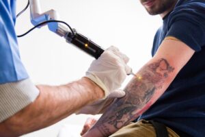 Laser Tattoo Removal in Dubai