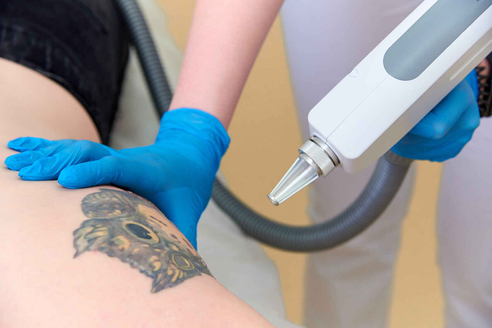 Laser Tattoo Removal in Dubai
