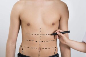Liposuction