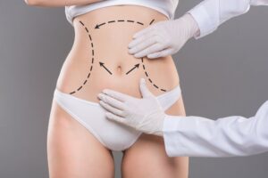 Liposuction in Dubai