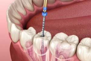 Root Canal Treatment in Dubai