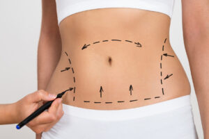 Tummy Tuck in Dubai