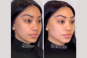 Best Plastic Surgeon in Dubai: How Long Do Thread Lifts Last? Expert Insights