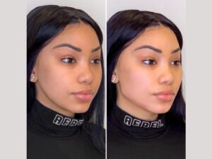 Best Plastic Surgeon in Dubai: How Long Do Thread Lifts Last? Expert Insights