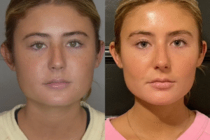 Buccal Fat Removal