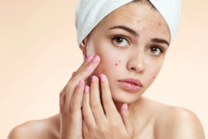 Acne Treatment In Dubai