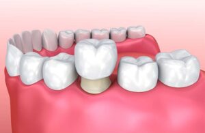 Dental Crowns and Bridges in Dubai