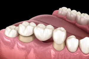 Dental Crowns and Bridges in Dubai