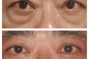 Eye Bag Removal