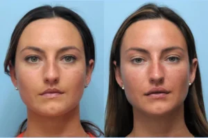 Thread Lift Treatments in Dubai: How It Compares to Traditional Facelifts