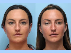 Thread Lift Treatments in Dubai: How It Compares to Traditional Facelifts