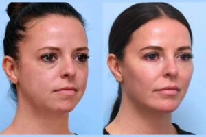 Secrets from the Best Doctors in Dubai on Successful Thread Lift Treatments