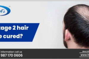 Stage 2 Hair Loss Treatment