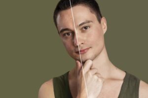 Acne Treatment In Dubai