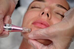 Mesotherapy in Dubai