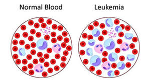 Leukemia Treatment Cost in India: Chemotherapy, Bone Marrow Transplant & More