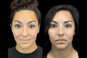 Botox in dubai