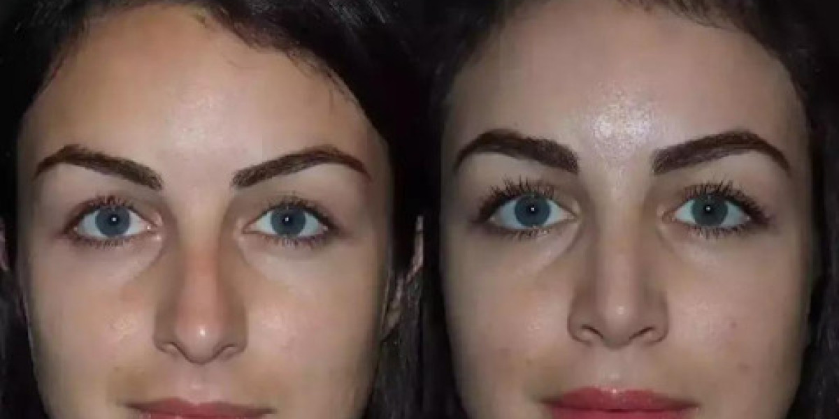 septoplasty in dubai