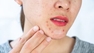 Does Acne Treatment Improve Overall Skin Health
