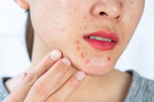 Does Acne Treatment Improve Overall Skin Health