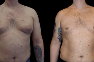 gynecomastia in dubai