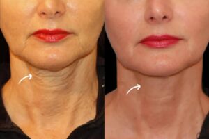 sculptra fillers in dubai