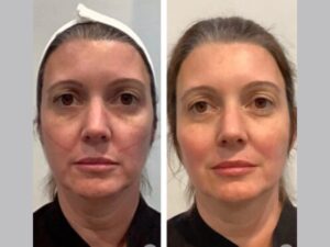 Discover Youthful Radiance with Advanced Thread Lift Treatments in Dubai