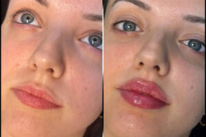 fillers in Dubai