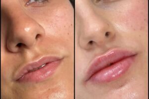Dermal Fillers in dubai